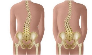 Ez-egiturazko scoliosis