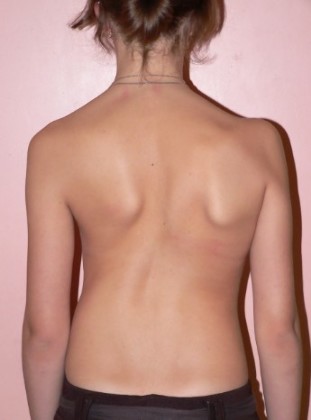 Scoliosis 2 gradu