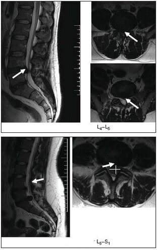 Bizkarrezurreko hernia diskoaren MRI eskaneatzea